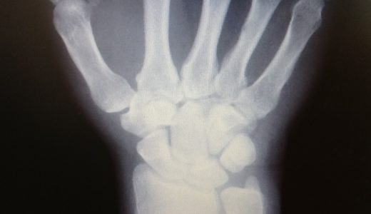 舟状骨骨折後遺症 / 手の付け根の痛み