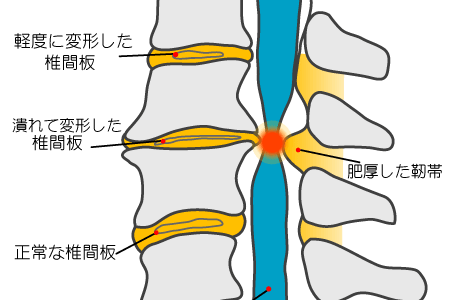 後縦靱帯骨化症 (OPLL ) / 首の痛み・手足のしびれ