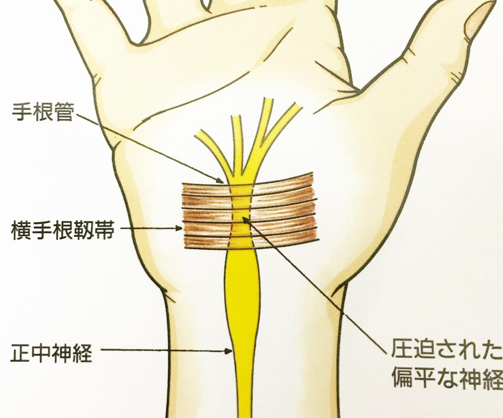 手根管を即座に和らげるにはどうすればよいですか?