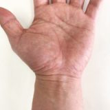 手根管症候群 / 手と指のしびれ