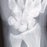 TFCC損傷 (三角線維軟骨複合体損傷) / 手首の小指側の痛み