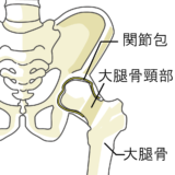 特発性大腿骨頭壊死症 / 股関節の痛み