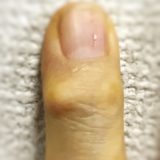 へバーデン結節(ヘベルデン結節) / 指の第1関節の腫れ