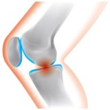 変形性膝関節症 / 膝（ひざ）の痛み