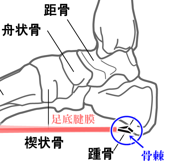 踵の骨棘