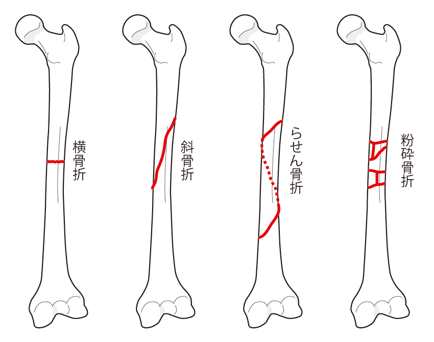 らせん骨折とは何ですか？